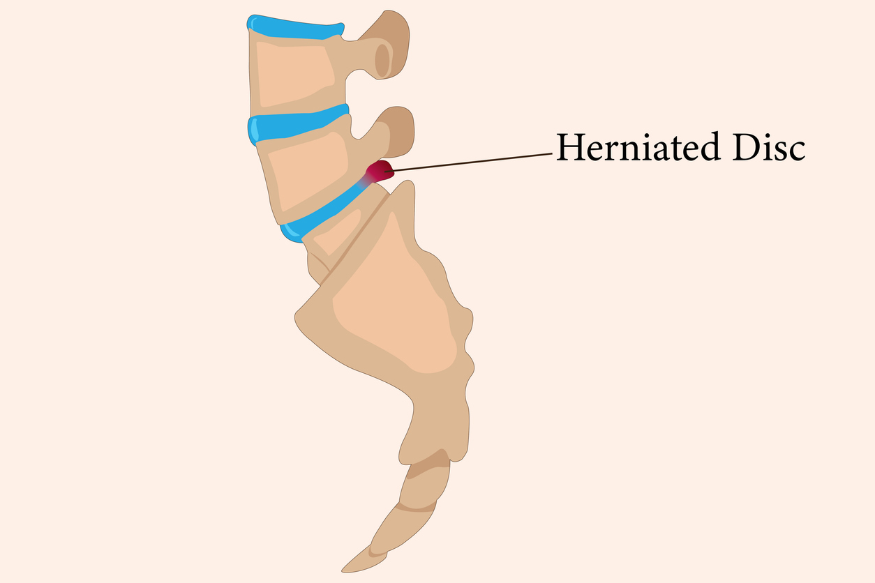 Herniated disc from a car wreck