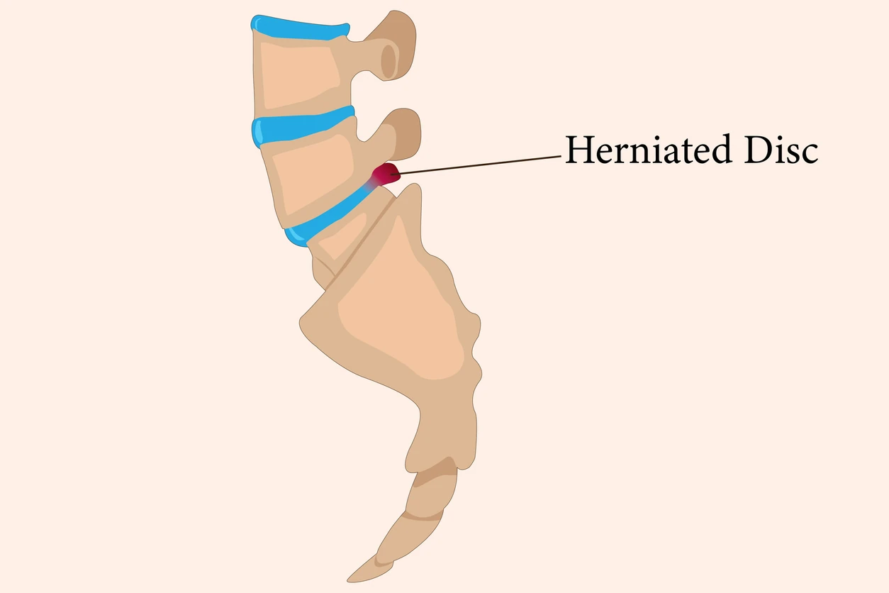 Herniated disc from a car wreck
